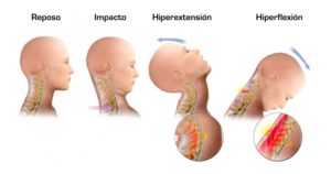 Esguince o latigazo cervical Ejercicios de rehabilitación Traumatopedia