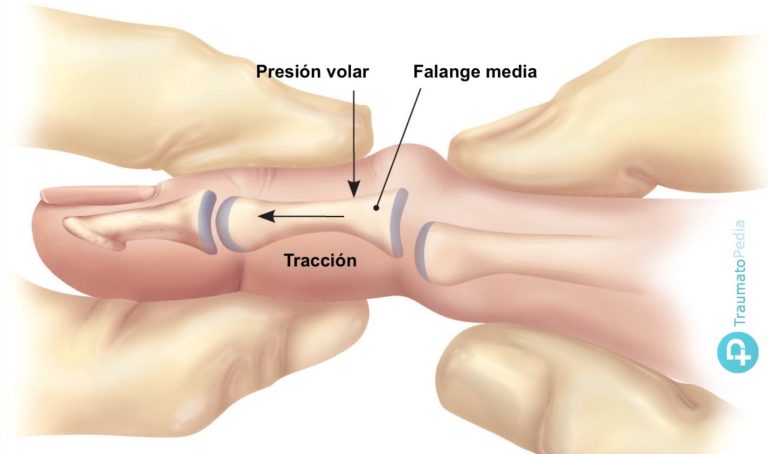 Luxaci N De Los Dedos De La Mano Diagn Stico Y Tratamiento Traumatopedia