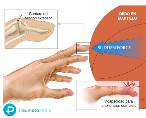 Dedo en garra - Tratamiento - Traumatopedia