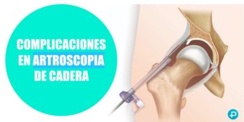 Complicaciones de la artroscopia de cadera