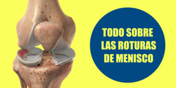 Cómo saber si tengo el menisco roto - Artroscopia de rodilla