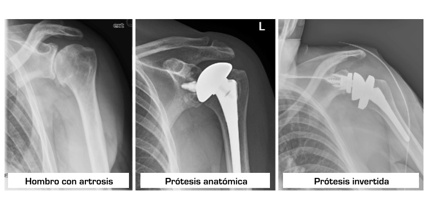 radiografía prótesis de hombro