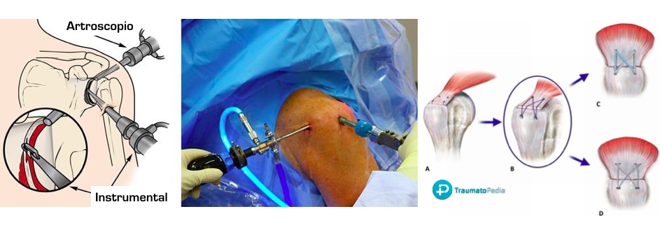 Artroscopia sutura tendón hombro
