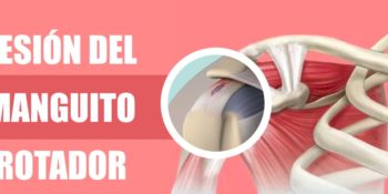 Rotura de los tendones del hombro - Manguito de los rotadores