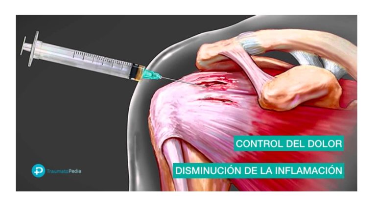 Rotura de los tendones del hombro - Manguito de los rotadores ...