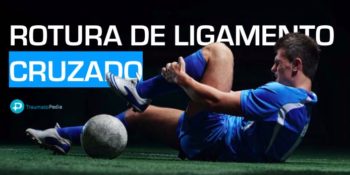 Tengo roto el ligamento cruzado anterior de la rodilla