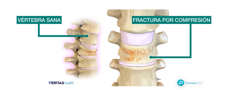 vertebra aplastada compresión osteoporosis