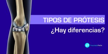 Tipos de prótesis de rodilla