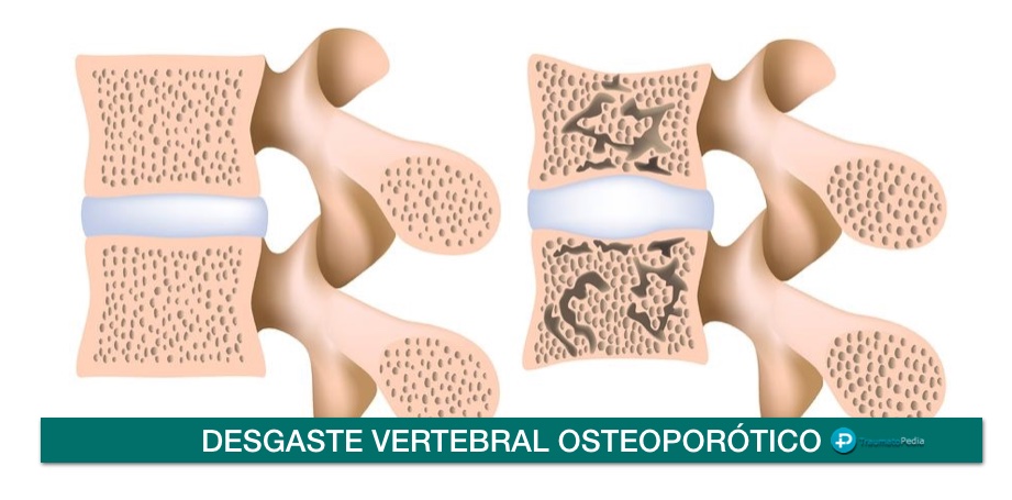 osteoporosis vertebra rota columna tratamiento