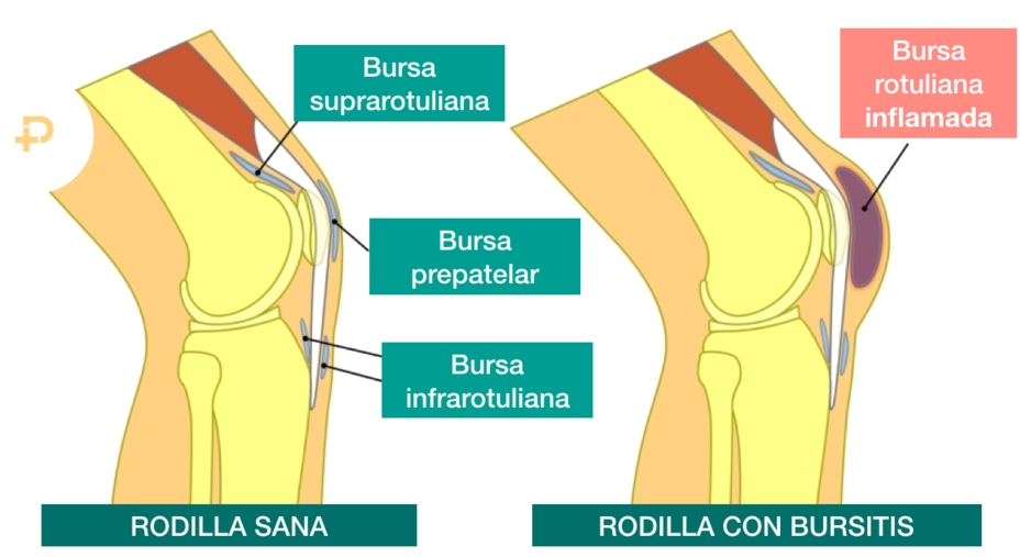 bursitis de rodilla
