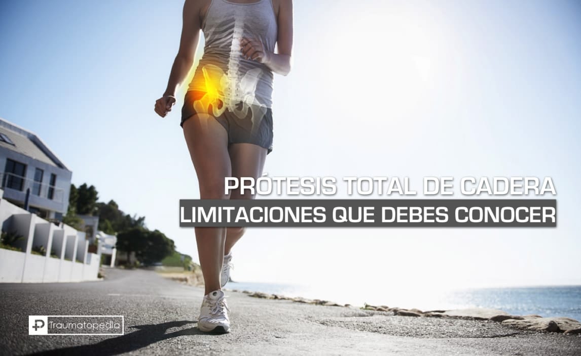 Limitaciones con prótesis de cadera