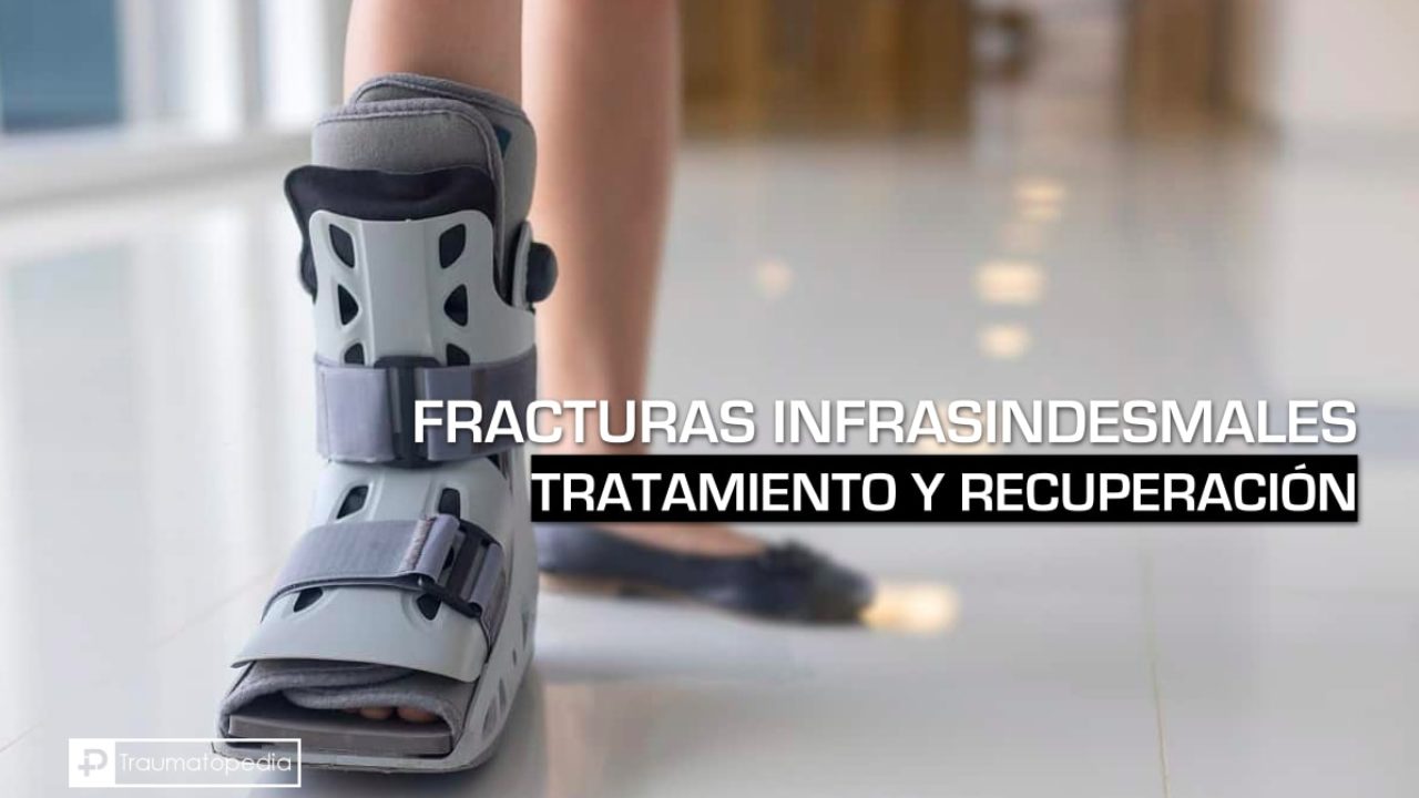 Se Puede Apoyar El Pie Con La Bota Walker Fractura infrasindesmal del maleolo externo - Tratamiento - Traumatopedia