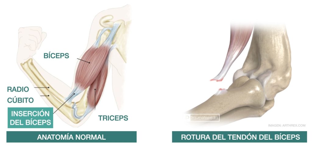 Rotura del bíceps distal