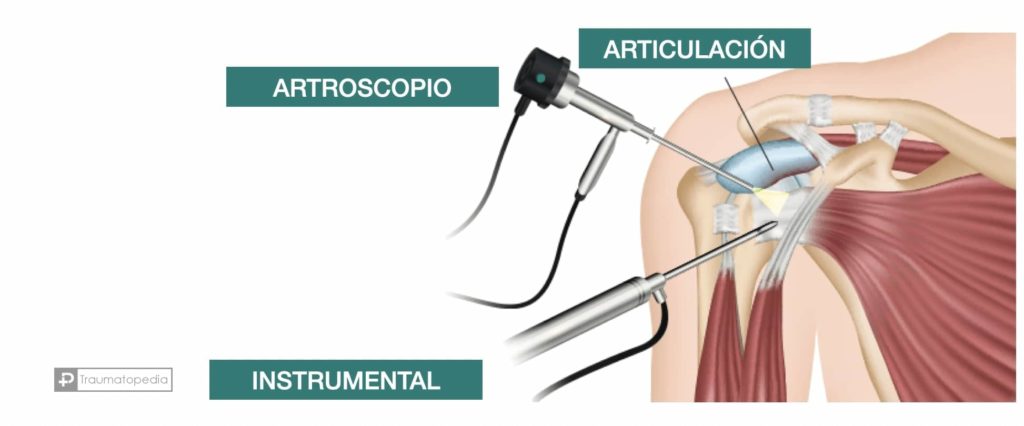 artroscopia de manguito hombro