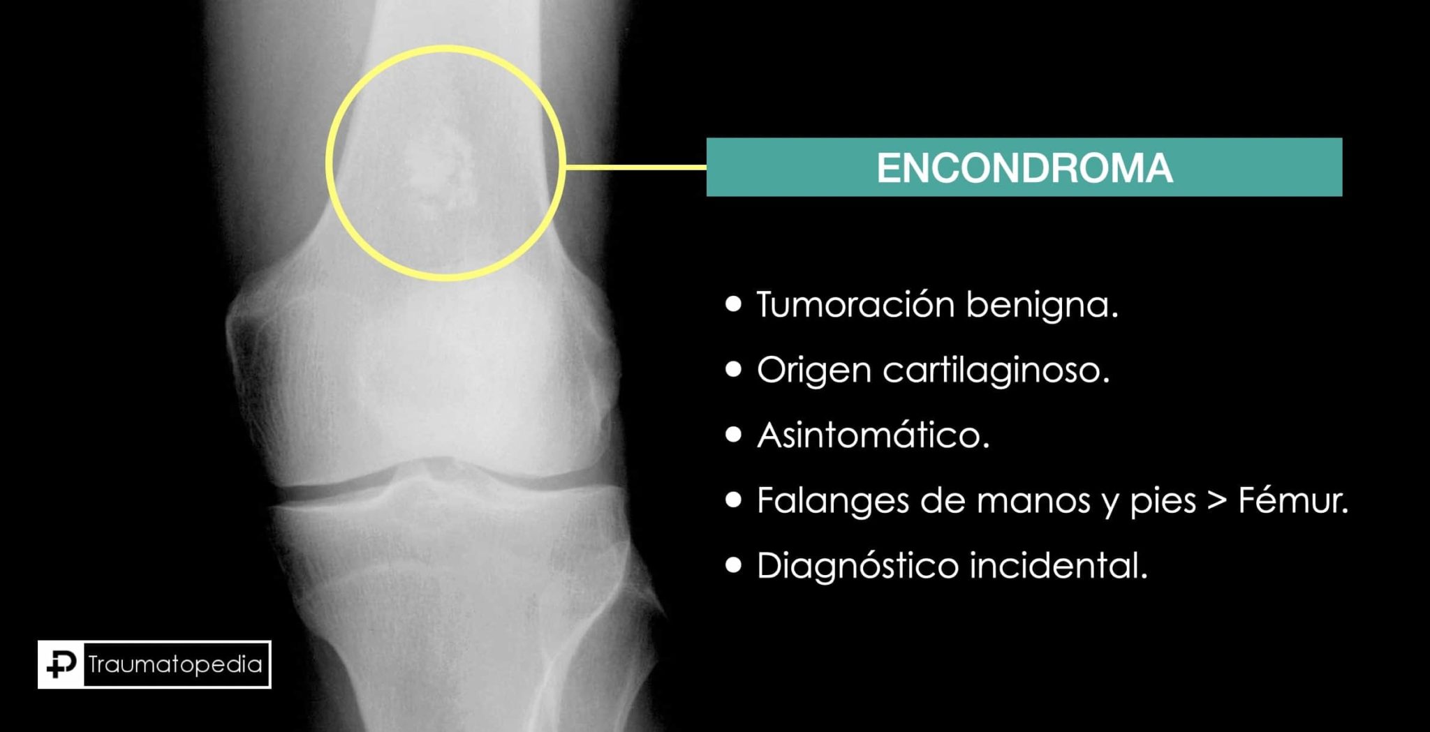 Tengo un encondroma - ¿Es grave? ¿Cuál es el tratamiento? - Traumatopedia