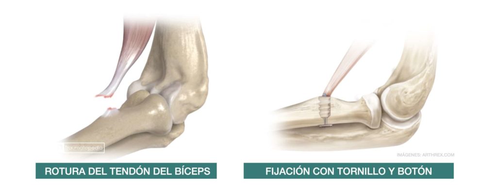 operación rotura tendón distal biceps