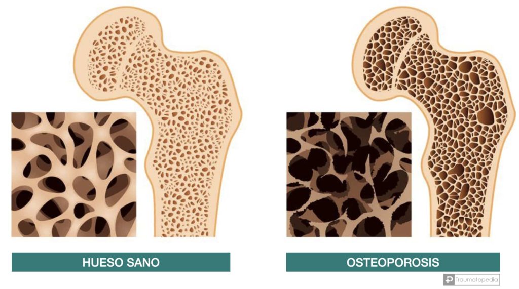 Osteoporosis sumplemento vitamina D colecalciferol - traumatopedia